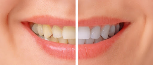 Start The New Year On A Bright Note. Stop By For The Best Teeth Cleaning Melbourne Has To Offer